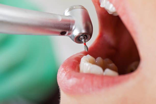Best Emergency Treatment for Dental Infections or Abscesses in Ann Arbor, MI